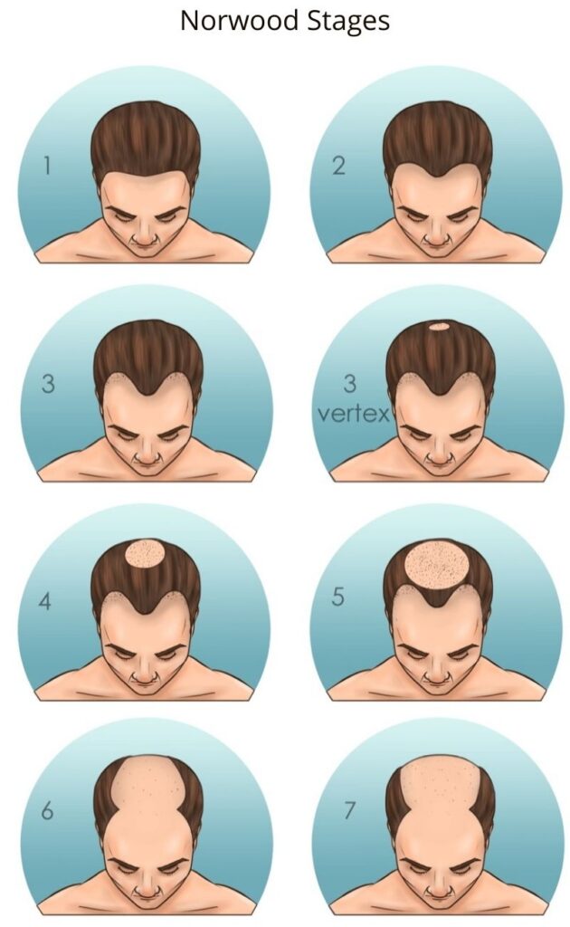 norwood-stages-for-male-receding-hairline-630x1024.jpg